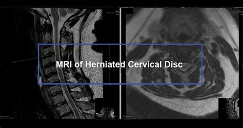 What Does a Cervical MRI Show: Exploring the Mysteries of the Neck and Beyond